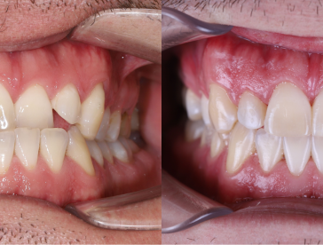 Элайнеры: до/после