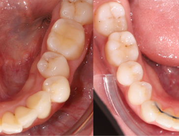 Элайнеры: до/после