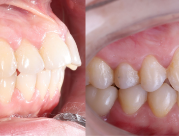 Элайнеры: до/после