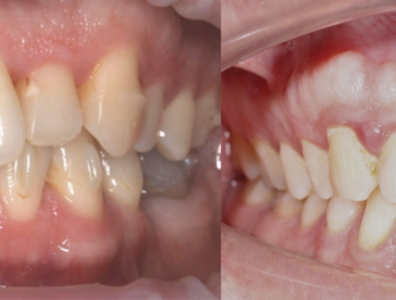 Элайнеры: до/после