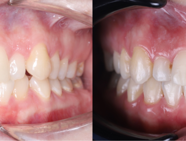 Элайнеры: до/после