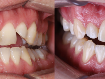 Элайнеры: до/после