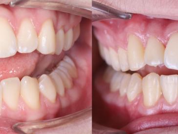 Элайнеры: до/после