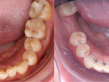 Элайнеры: до/после